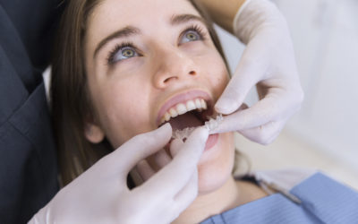 5 razones para elegir la ortodoncia invisible